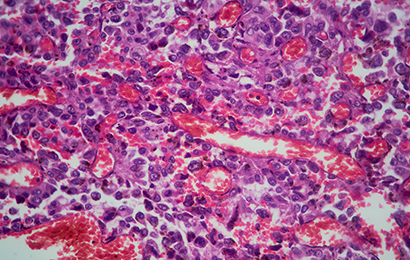 Nierenkrebs Kartenbild